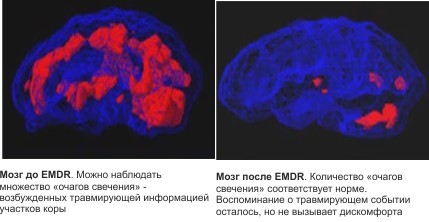 МРТ мозга до и после EMDR-терапии